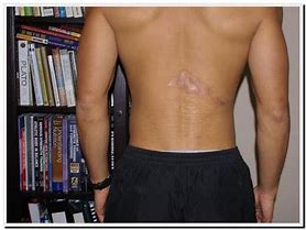 Image result for Battle Scars On Back
