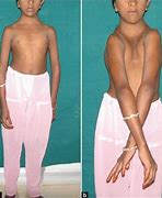 Image result for Cleidocranial Dysplasia