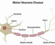 Image result for Motor Neurone Disease