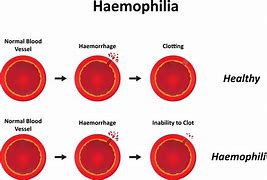 Image result for Hemophilia Drawing