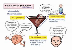 Image result for Fetal Alcohol Spectrum Disorder