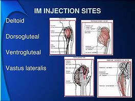 Image result for Ventrogluteal Intramuscular Injection Sites
