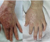 Image result for Healed Burn Scars
