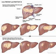 Image result for Liver Cancer Stages