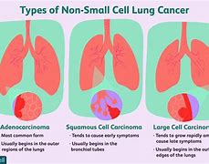 Image result for Stage 4 Non-Small Cell Lung Cancer