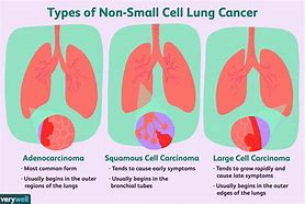 Image result for Lung Carcinoma Types