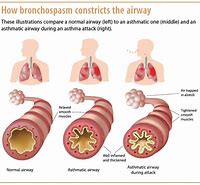 Image result for Patient with Asthma