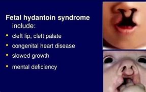 Image result for Fetal Hydantoin Syndrome