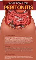 Image result for Peritonitis
