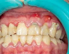 Image result for Bad Oral Hygene