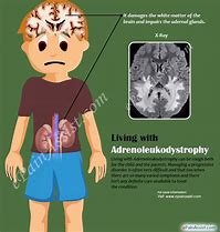 Image result for Adrenoleukodystrophy Disease