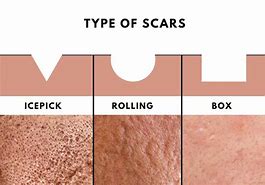 Image result for Acne Scar Types