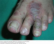 Image result for Tinea Pedis Cellulitis
