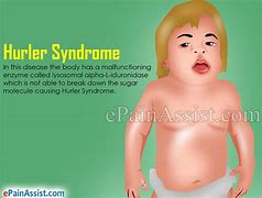 Image result for Hurler Syndrome Adult