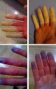 Image result for Syndrome De Raynaud