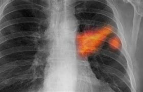 Image result for Stage 4 Metastasized Lung Cancer