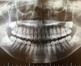 歯のレントゲン　フリー素材 に対する画像結果