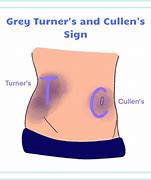 Image result for Grey Turner Sign Pancreatitis
