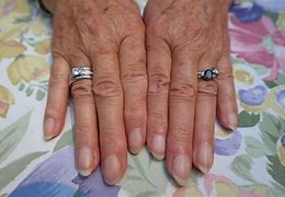Image result for Dents in Fingernails