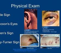 Image result for Battle Sign On Exam