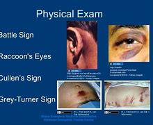 Image result for Battle Sign Trauma