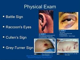 Image result for Battle Signs After Head Injury