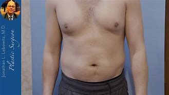 Image result for Gynecomastia Steroids