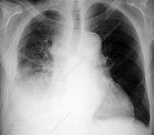 Image result for Stage 4 Small Cell Lung Cancer