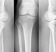 Image result for Osteoporosis X-ray vs Normal