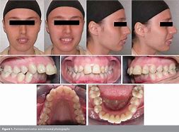 Image result for Class II Malocclusion