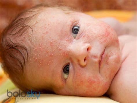 Skin Problems In Babies  Home Remedies   Boldsky 