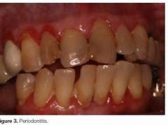 Image result for Periodontal Disease Problem