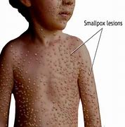 Image result for Smallpox Symptoms
