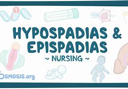 Image result for Epispadias vs Hypospadias