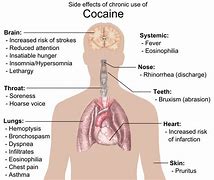 Image result for Cocaine Side Effects