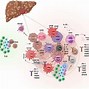 Image result for Hepatic Cancer