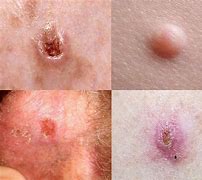 Image result for All Types of Skin Cancer