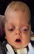 Image result for Pfeiffer Syndrome as an Adult