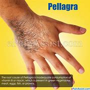 Image result for Pellagra
