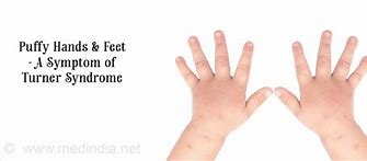 Image result for Turner Syndrome Hands