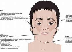 Image result for Treacher Collins Syndrome Life Expectancy