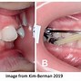 Image result for Carriere Appliance Orthodontics Class III with Clear Aligners