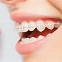 Image result for Ceramic Fixed Braces