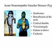 Image result for Gaucher Disease Facies