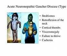 Image result for Famous People with Gaucher Disease