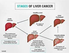 Image result for Stage 4 Liver Cancer Prognosis