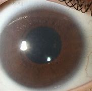 Image result for Hurler Syndrome Eye