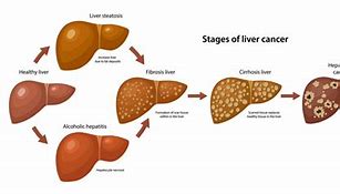 Image result for Stage 4 Small Cell Lung Cancer Metastasized to Liver