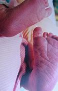 Image result for Acrocyanosis Baby