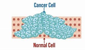 Image result for Stage 4 Cancer Cells